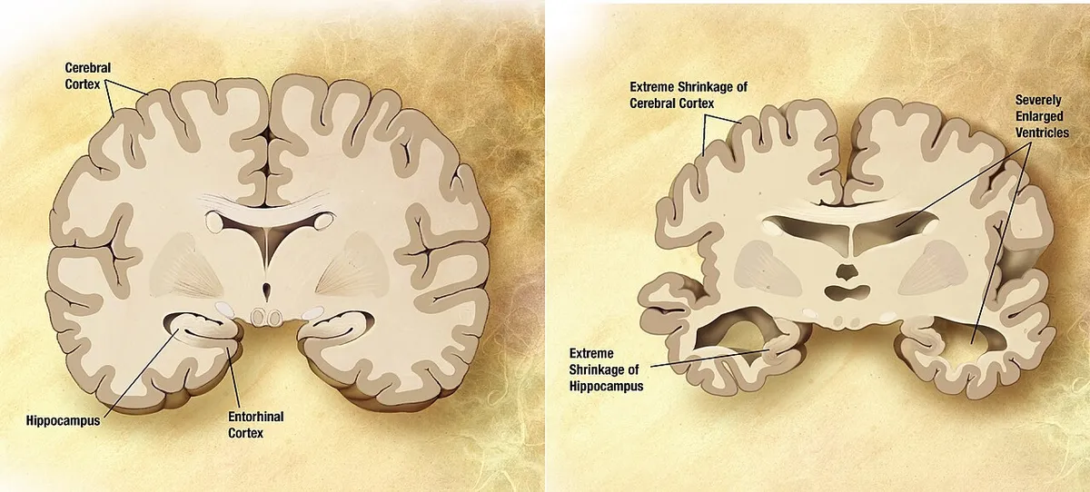 Doença de Alzheimer