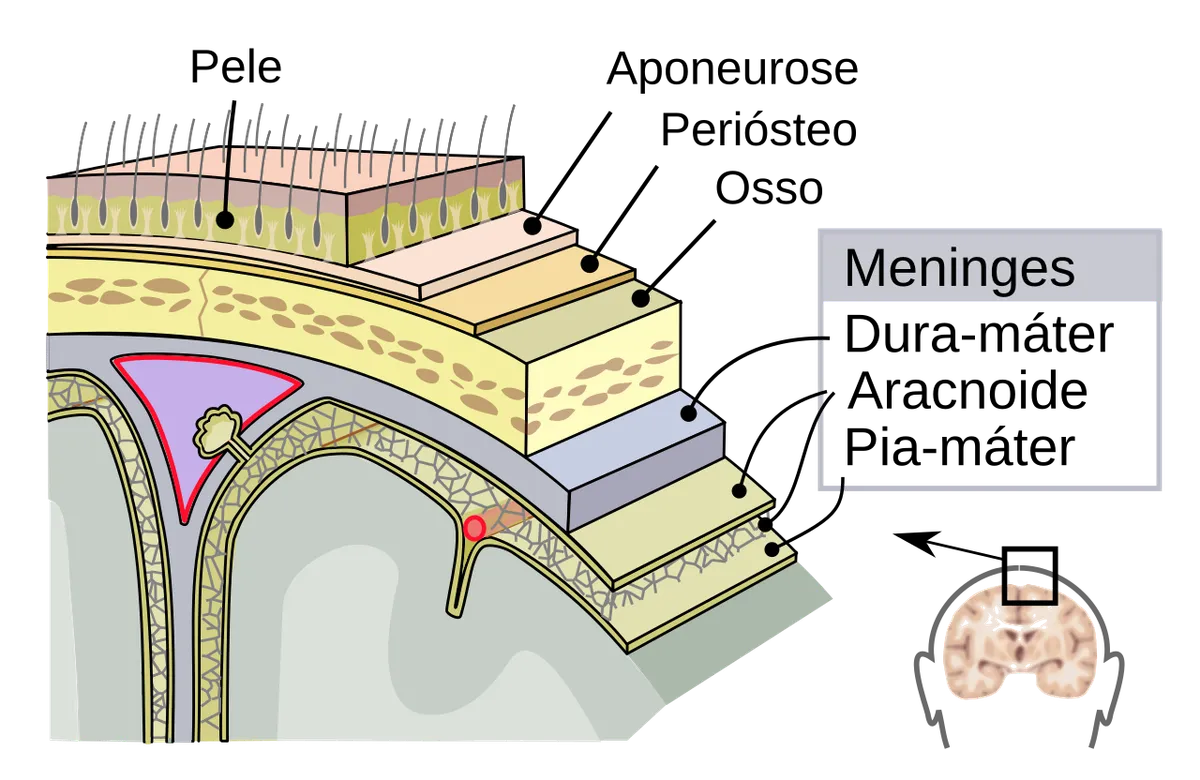 Meningite