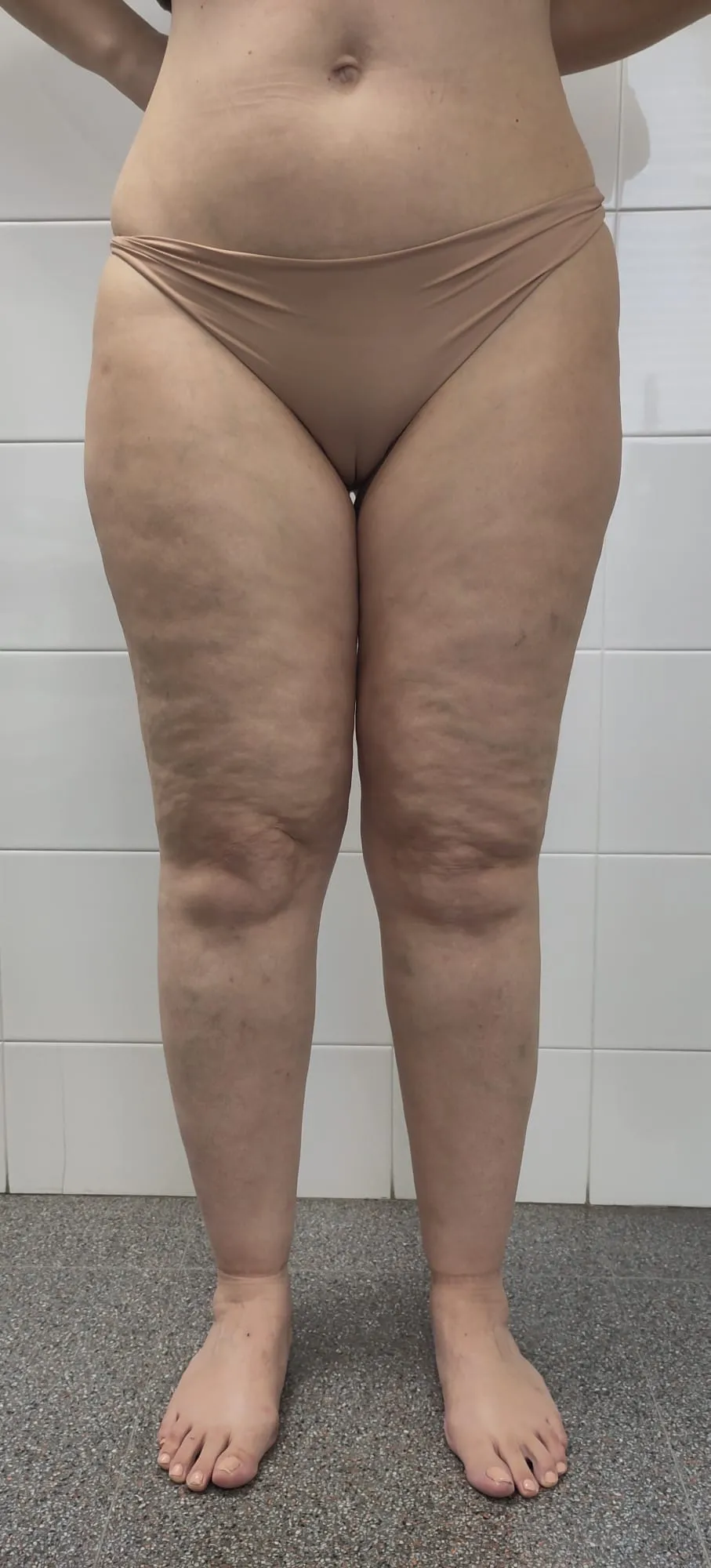 Lipedema