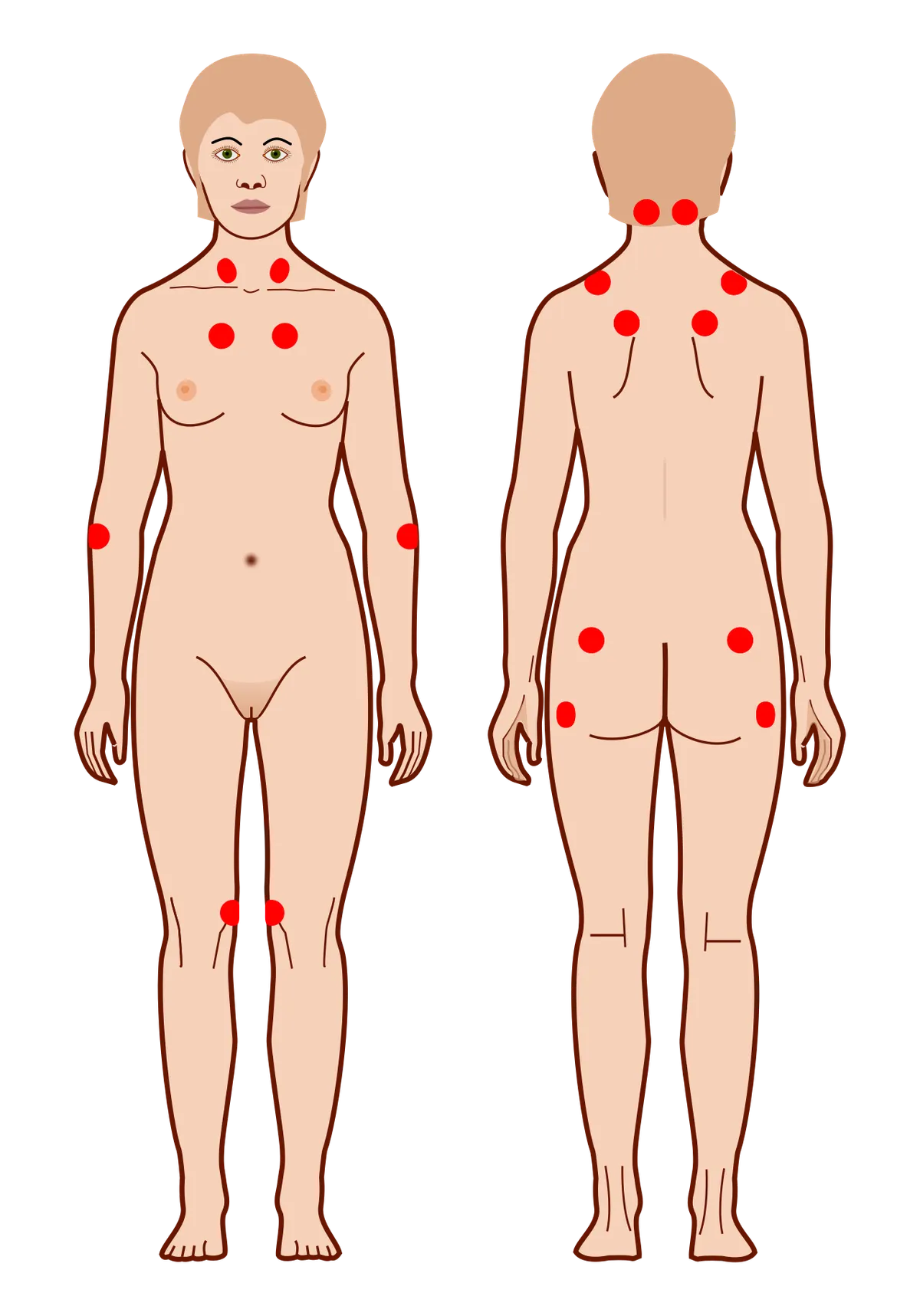 Fibromialgia